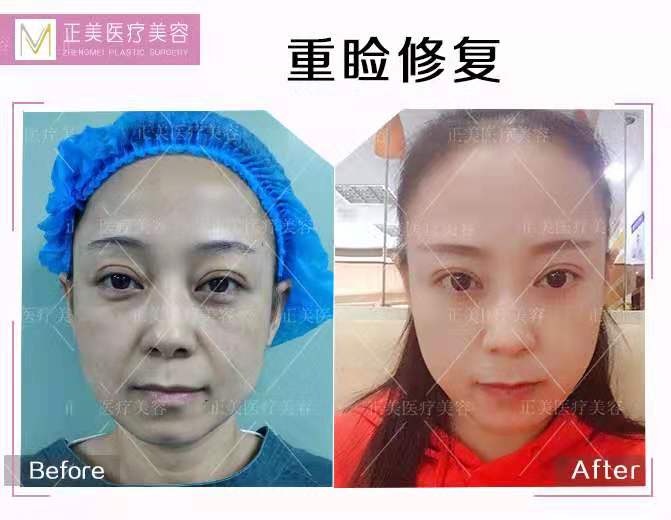 鄭永生雙眼皮修復案例
