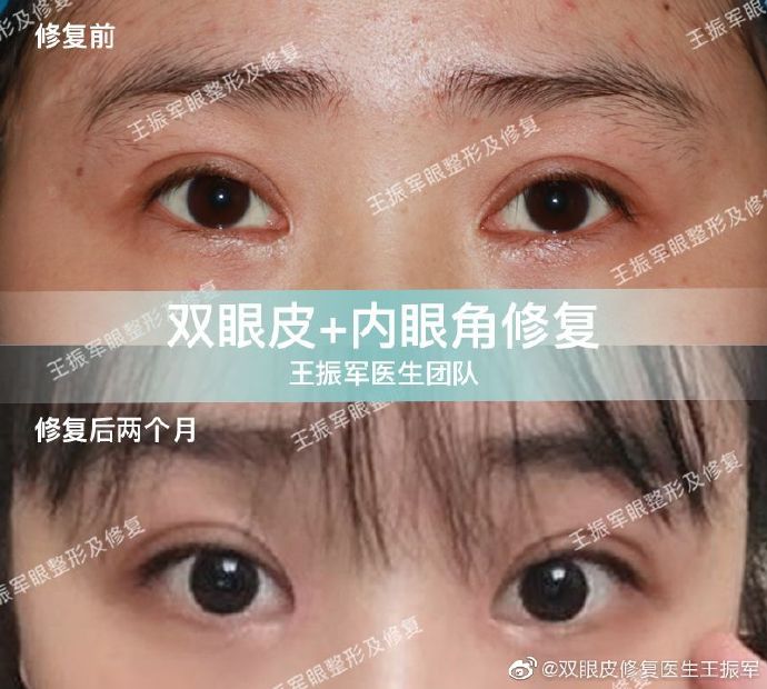 王振軍雙眼皮修復案例