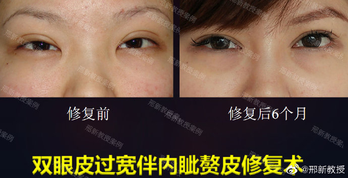 邢新雙眼皮修復案例