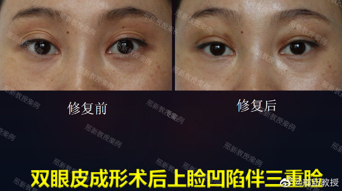 邢新雙眼皮修復案例