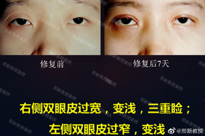 邢新雙眼皮修復案例