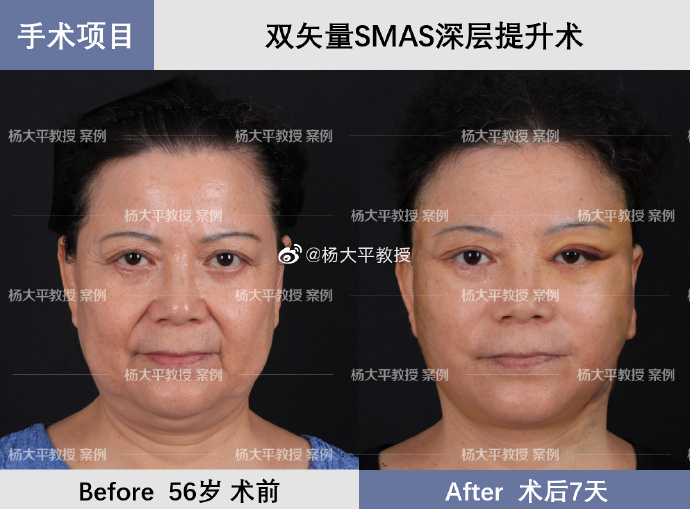 楊大平面部提升案例