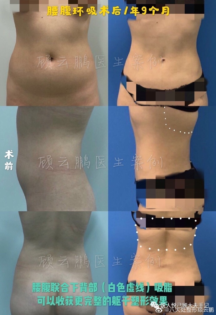 顧云鵬腰腹吸脂案例