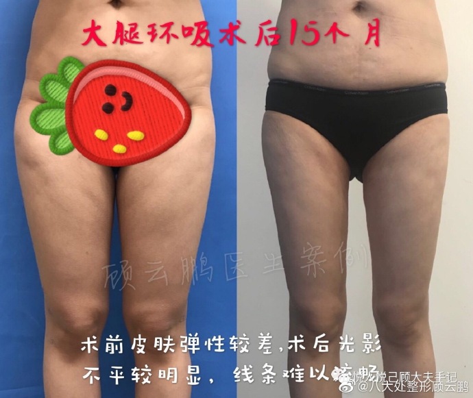 顧云鵬大腿吸脂案例