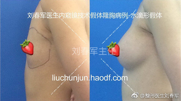 劉春軍豐胸案例