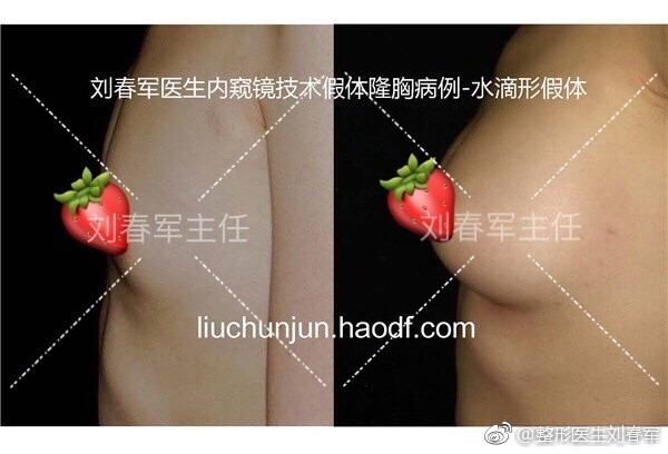 劉春軍豐胸案例