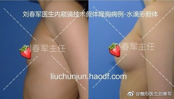 劉春軍豐胸案例