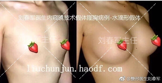 劉春軍豐胸案例