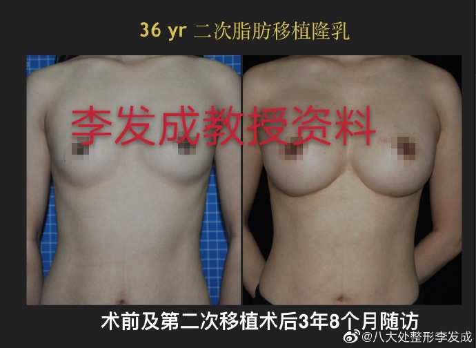 李發(fā)成自體脂肪豐胸案例