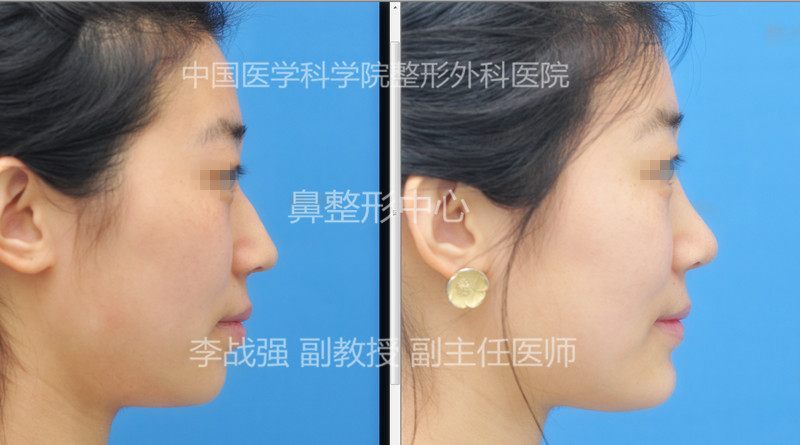 李戰(zhàn)強鼻修復案例
