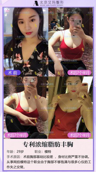 韋元強濃縮脂肪豐胸案例