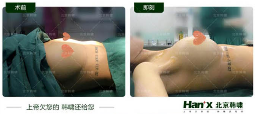 侯澤民脂肪豐胸案例