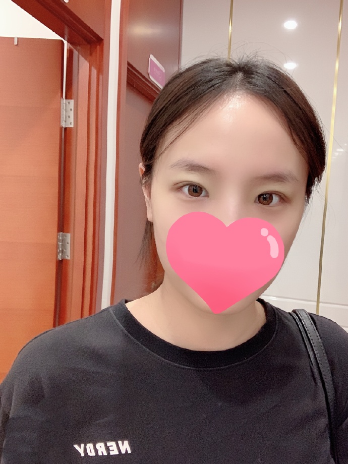 靳小雷、王世勇和韓勛哪個雙眼皮修復(fù)好？