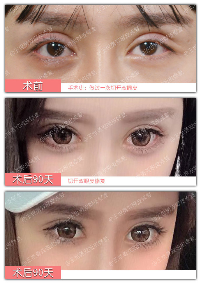 王世勇雙眼皮修復案例