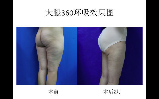 曹衛剛大腿環吸案例