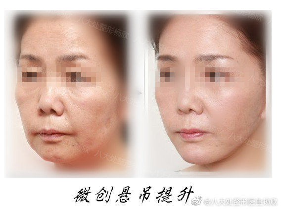 楊欣面部提升案例