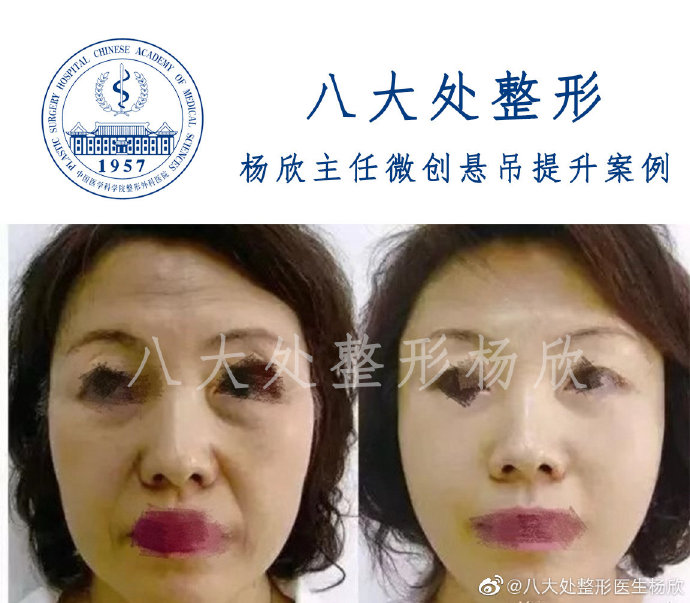 楊欣面部提升案例