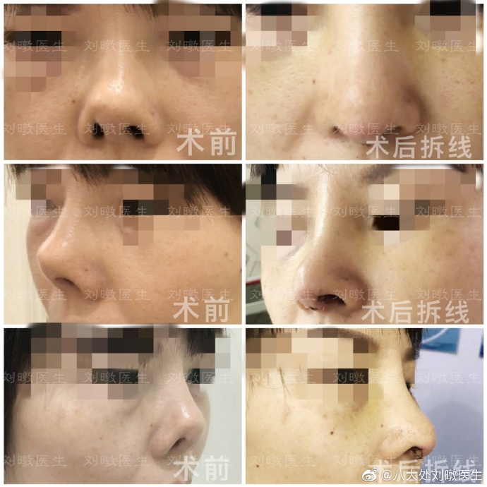 劉暾鼻修復案例