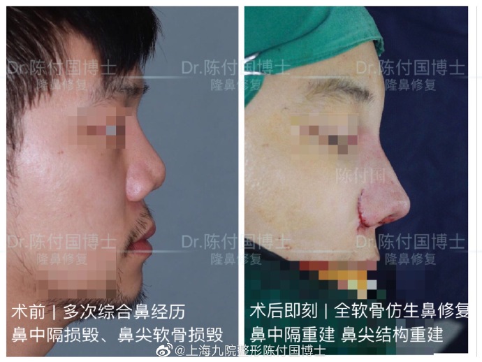 陳付國鼻修復案例