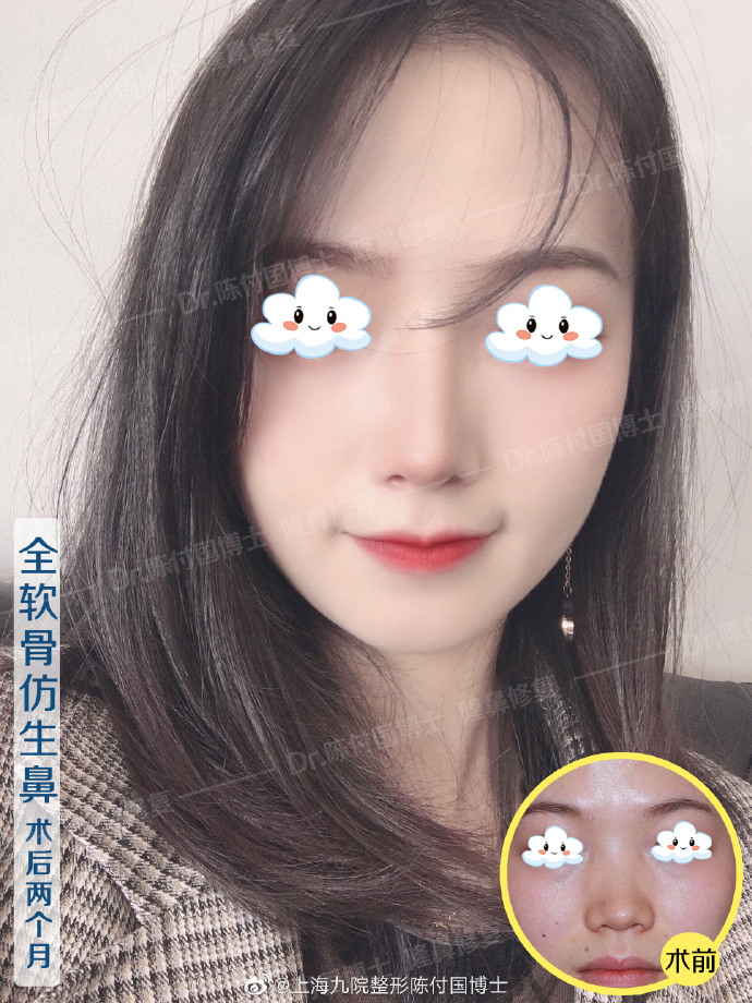 陳付國鼻綜合案例