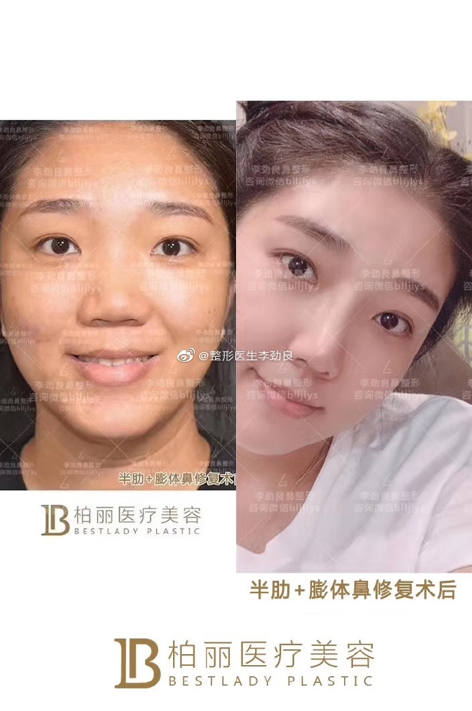 李勁良鼻綜合