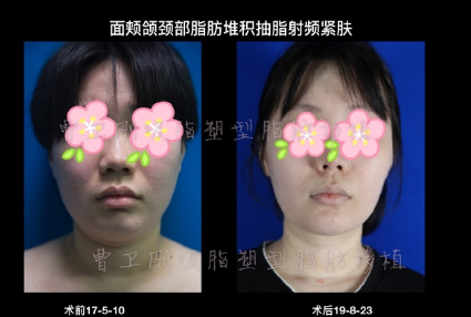 曹衛(wèi)剛面部吸脂案例