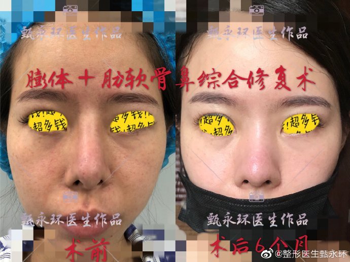 甄永環鼻綜合案例