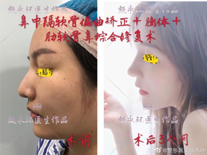 甄永環鼻綜合案例