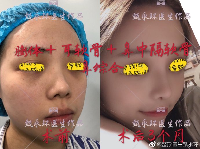 甄永環鼻綜合案例