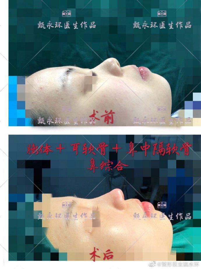 甄永環鼻綜合案例