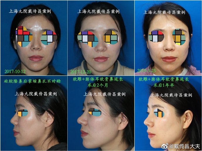 戴傳昌鼻修復案例