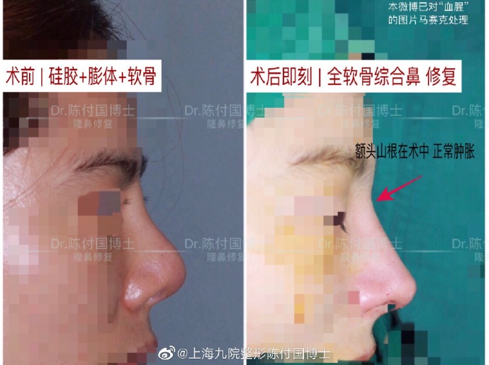 陳付國鼻修復案例