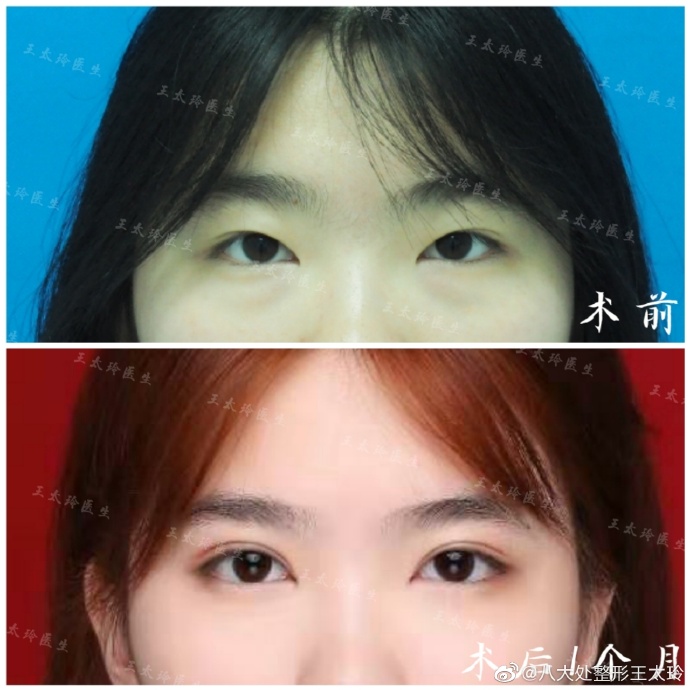 王太玲雙眼皮案例