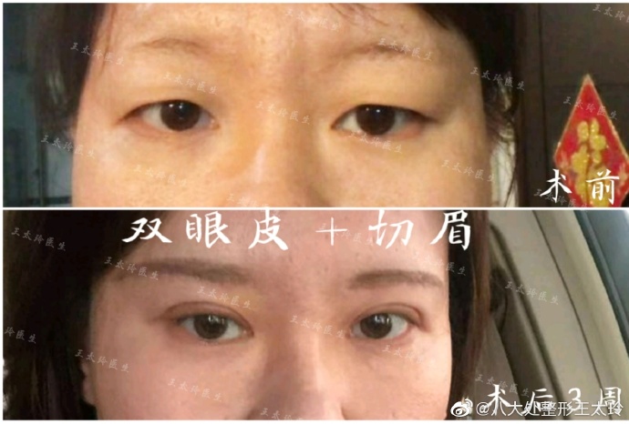 王太玲雙眼皮案例
