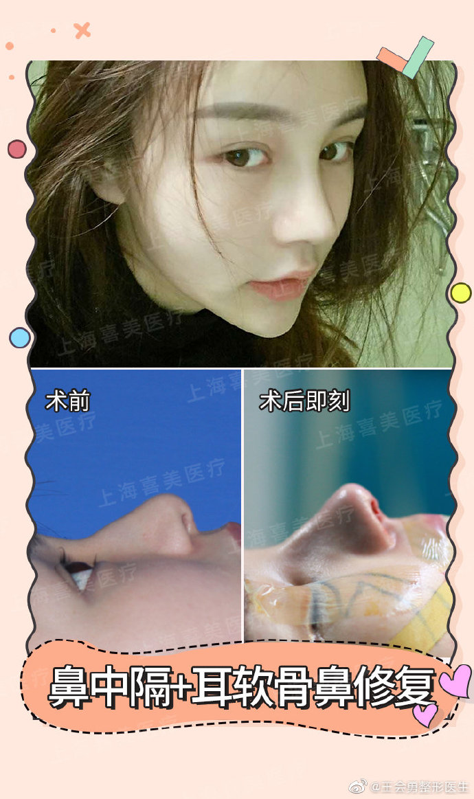 王會勇鼻修復案例
