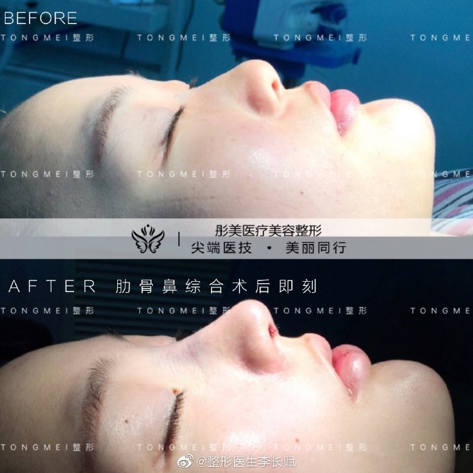 李長賦鼻綜合案例