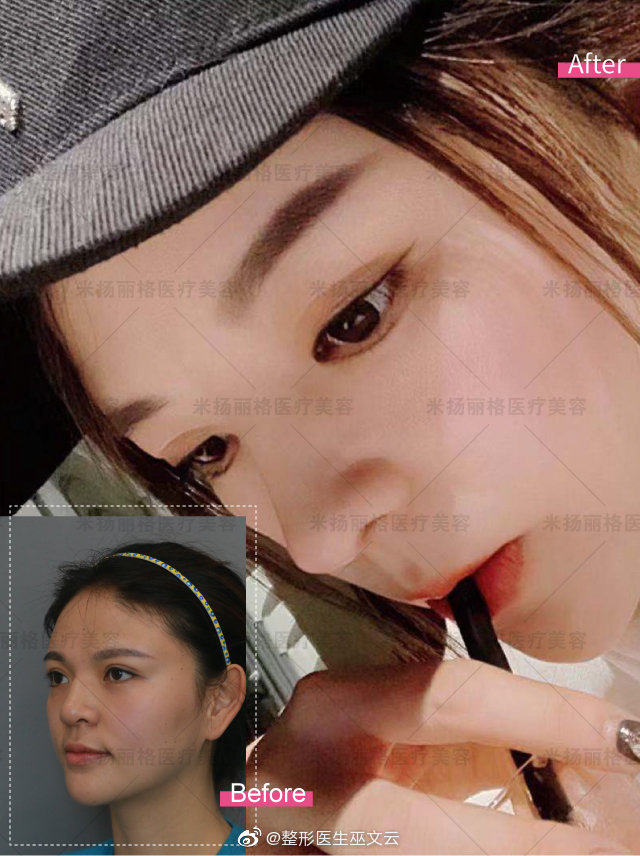 巫文云鼻修復案例