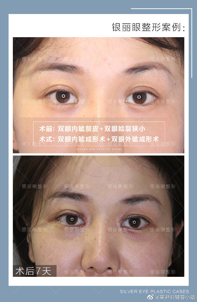 劉輔容雙眼皮修復案例