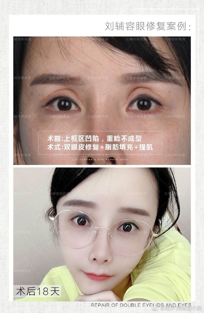 劉輔容雙眼皮修復案例