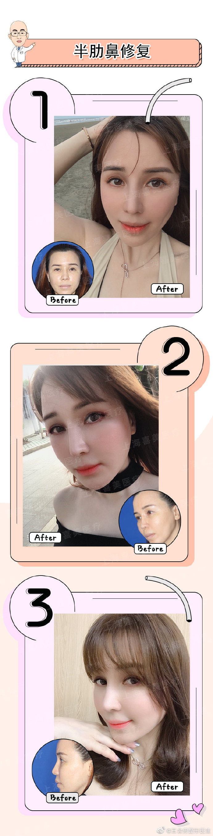 王會勇鼻修復案例
