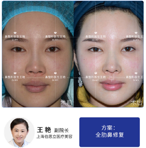 王艷鼻修復案例