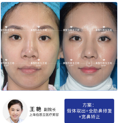 王艷鼻修復案例