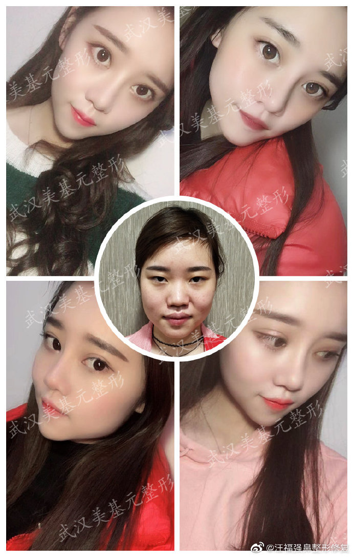 汪福強鼻整形案例