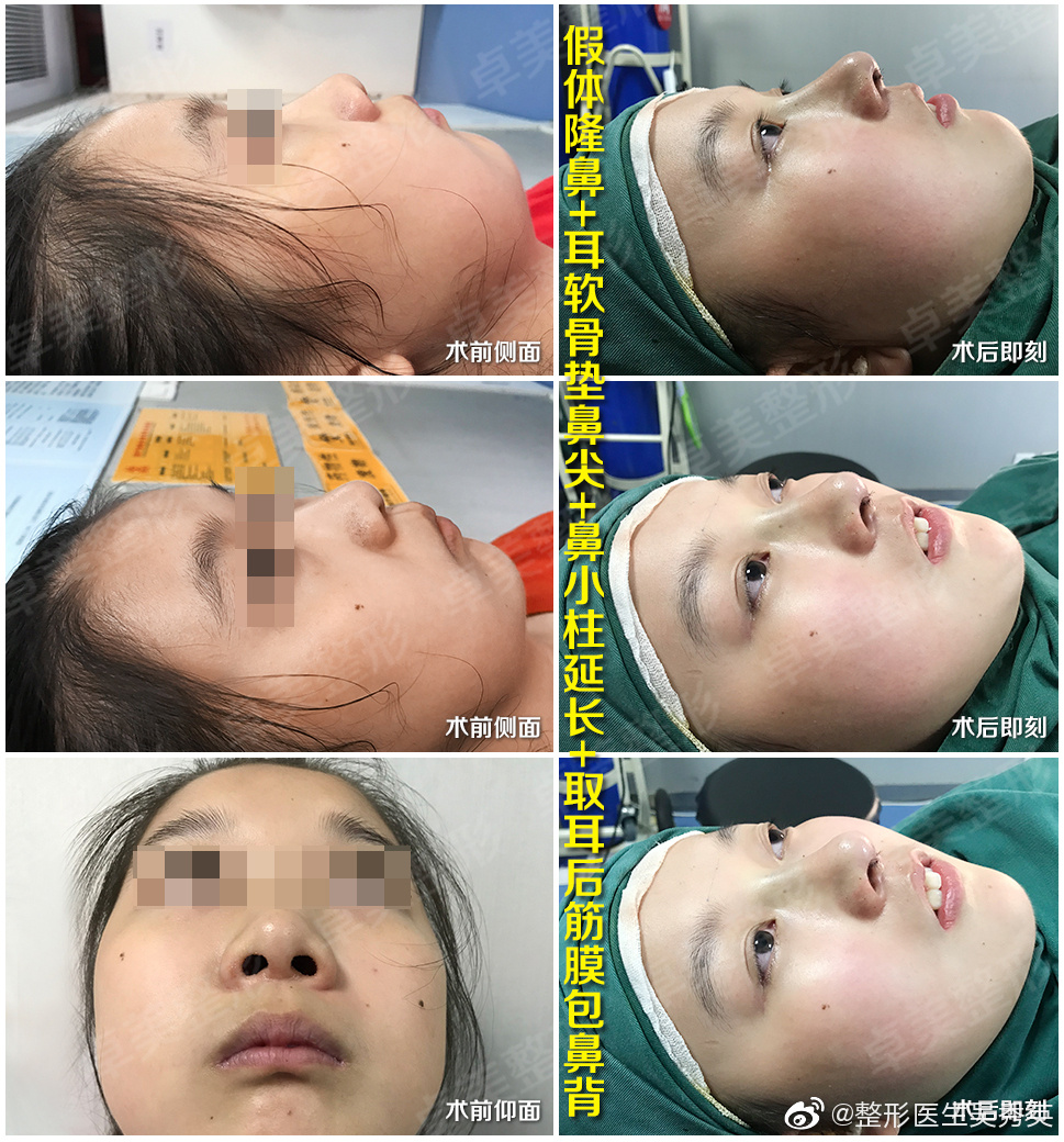 吳秀英鼻整形案例