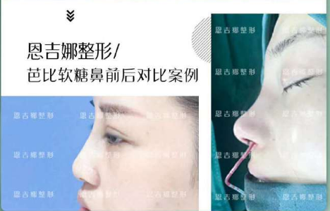 付榮峰鼻整形案例
