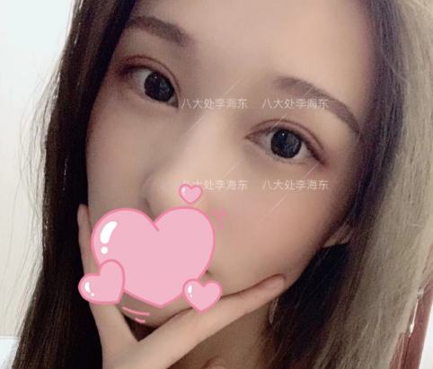 李海東雙眼皮案例