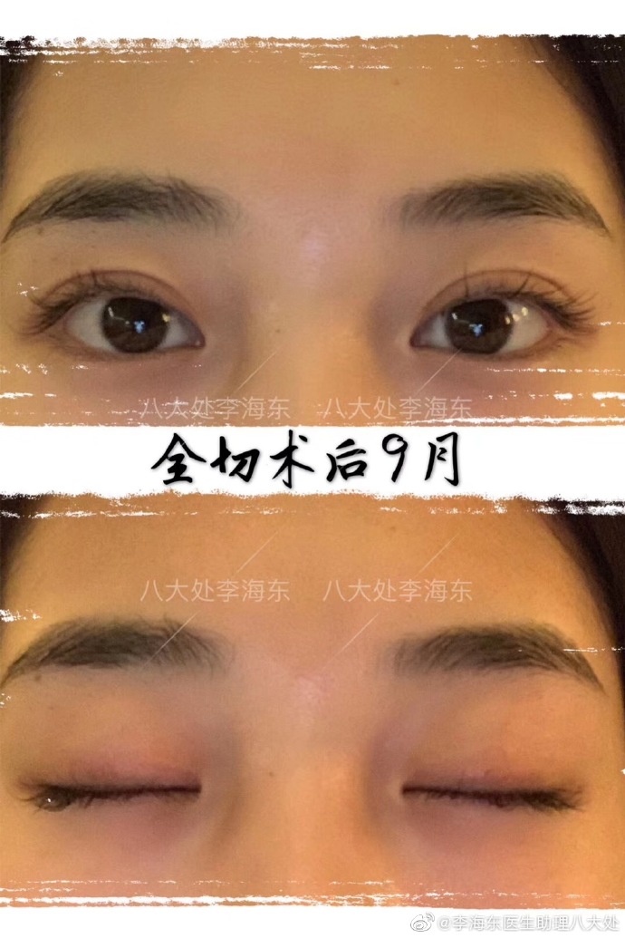 李海東雙眼皮案例