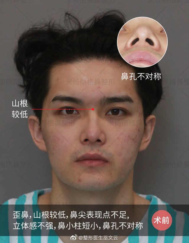 巫文云鼻修復案例