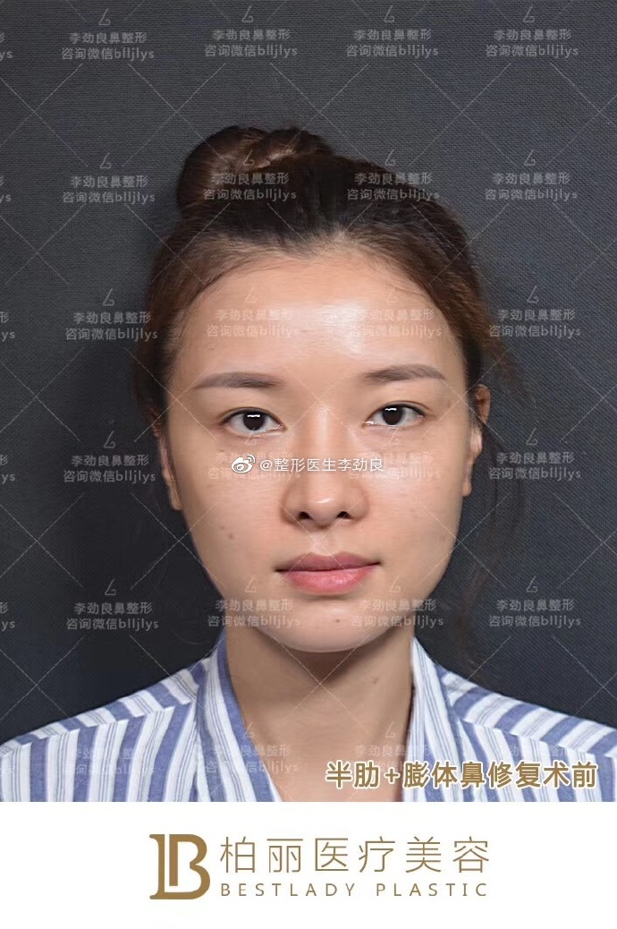 李勁良鼻修復案例