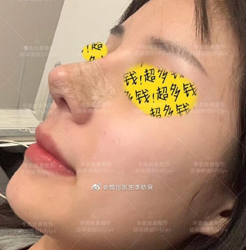 李勁良鼻修復(fù)案例